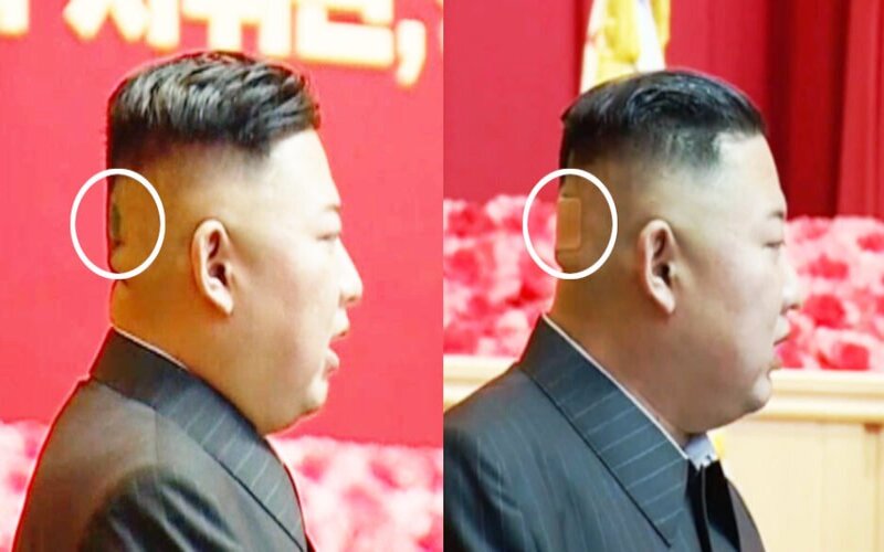Plaster di belakang kepala Pemimpin Korea Utara Kim Jong Un -  NK News.org