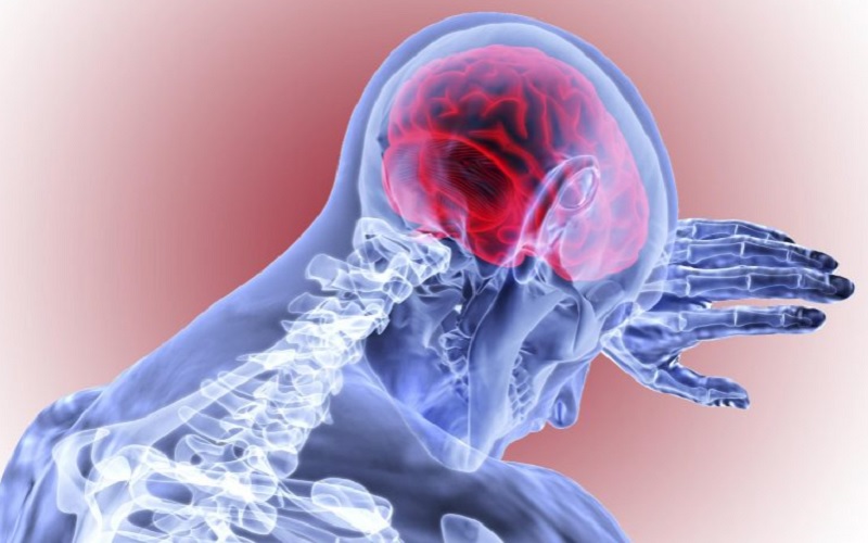 Ilustrasi pendarahan otak - scitechdaily.com