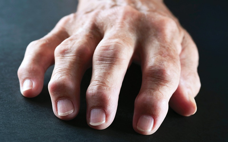 10 Rarely Known Rheumatism Symptoms