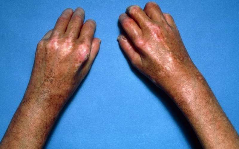 Recognize 10 Symptoms of Diabetes from Skin Problems