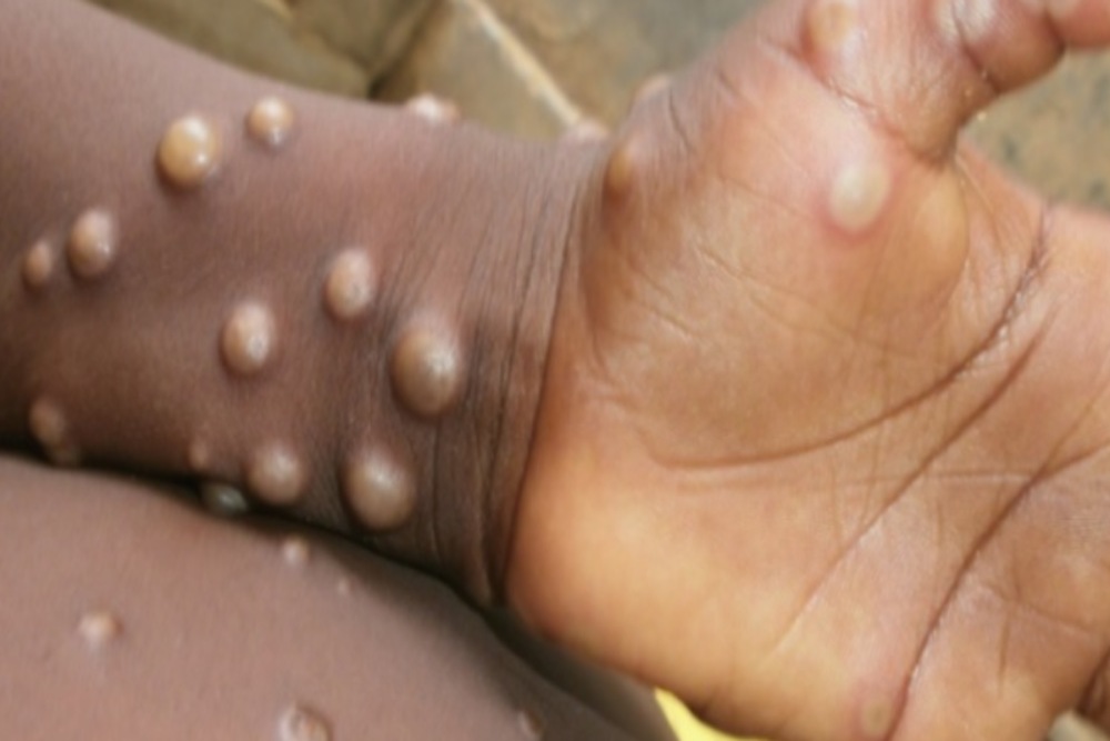 Penyakit cacar monyet atau monkeypox mewabah di Inggris, Portugal dan Spanyol. - Istimewa