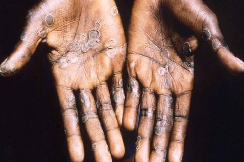Ilustrasi tangan seseorang terinfeksi virus cacar monyet atau Monkeypox - BBC