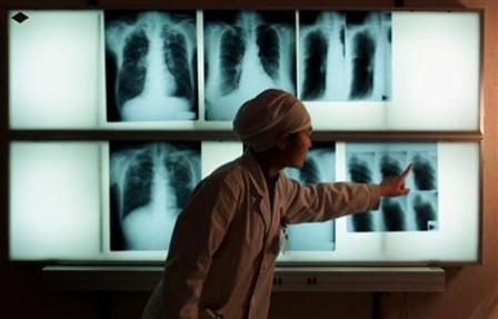 Indonesia Hadapi Kasus TB MDR dan TB Dengan HIV