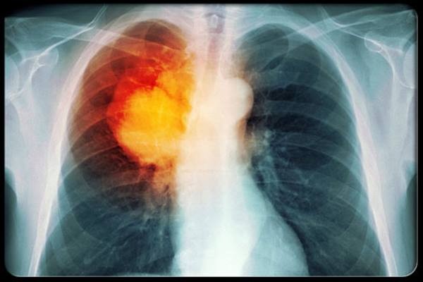 Gejala kanker paru-paru