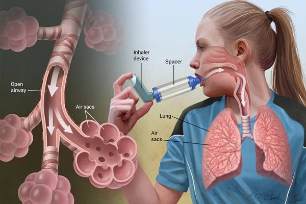 Penyakit asma - Istimewa