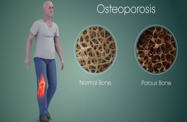 Tips Mencegah Osteoporosis
