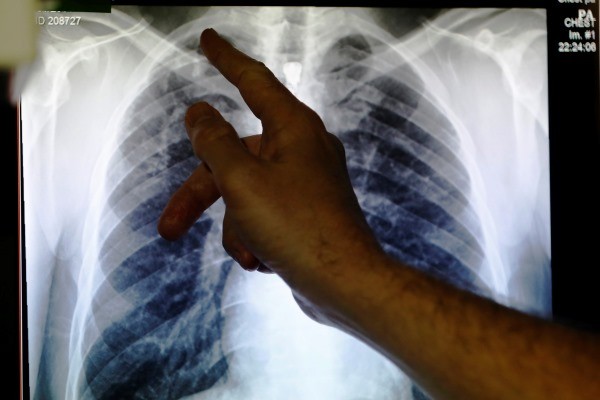 Foto rontgen sinar-X menunjukkan paru-paru yang terinfeksi tuberkulosis. - Reuters/Luke MacGregor