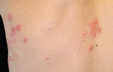 Herpes zoster - dermafoto.com