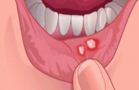 Perhatikan, Kondisi Mulut Anda Bisa Menjadi Tanda Gejala Diabetes Tipe 2