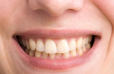 Mengenal Bruxism, Kebiasaan Menggemeretakkan Gigi yang Disebabkan Stres