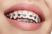 Bukan untuk Gaya, Ini 5 Alasan Kenapa Perlu Pakai Kawat Gigi