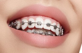 Bukan untuk Gaya, Ini 5 Alasan Kenapa Perlu Pakai Kawat Gigi