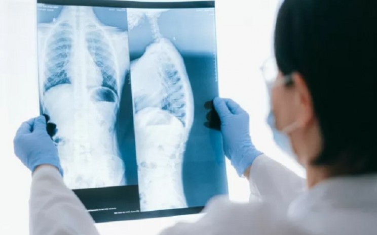 Ilustrasi dokter melihat hasil rontgenparu-paru. - Antara