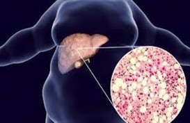 Kenali Gejala Kerusakan Liver atau Sirosis Berikut Ini