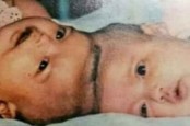 Viral Kisah Melawan Takdir Dokter Padmosantjojo, Bawa Keajaiban Operasi Kembar Siam Dempet Kepala