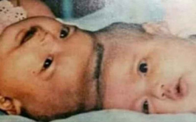 Bayi Kembar Siam Yuliana Yuliani yang dioperasi oleh Dokter Padmo - Twitter/FYudiWibowo4