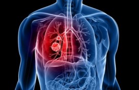 Tanda-tanda Kanker Paru-paru di Jari, Wajah, Leher dan Bahu Anda