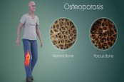 Tanda-tanda Awal Anda Mengalami Osteoporosis, Termasuk Tinggi Badan Berkurang
