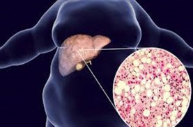 Kenali Apa Itu Penyakit Infeksi Liver dan Paru-paru…