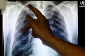 Wajib Tahu! 9 Mitos dan Fakta Seputar Penyakit Paru-paru