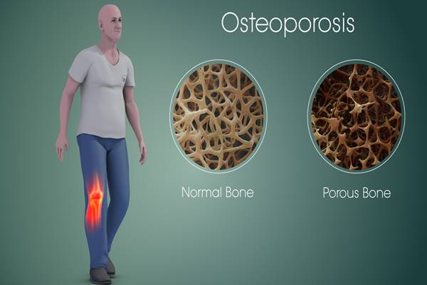 Pengeroposan tulang (osteoporosis) - Istimewa