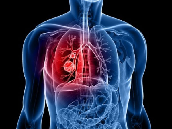 Ilustrasi kanker paru - Istimewa