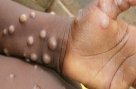 WHO: 92 Kasus Cacar Monyet (Monkeypox) dari Afrika…