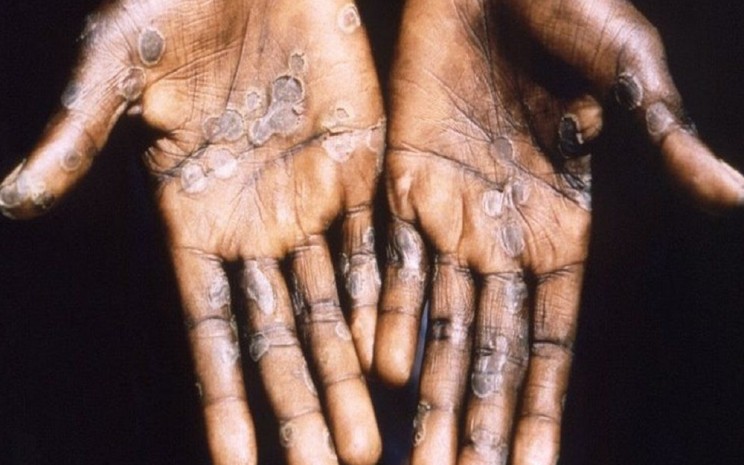 Ilustrasi tangan seseorang terinfeksi virus cacar monyet atau Monkeypox - BBC