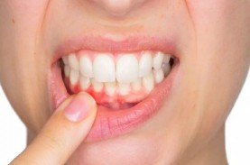 Penyebab dan Cara Mencegah Gingivitis, Jangan Anggap…