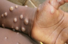 9 Kasus Suspek Monkeypox, Ini Jawaban Menkes Budi