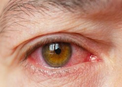 Penyebab Sindrom Mata Kering dan Tanda-tandanya