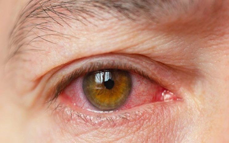 Penyebab Sindrom Mata Kering dan Tanda-tandanya