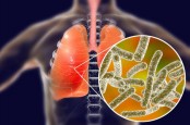 Gejala Pneumonia Misterius, Penyakit yang Disebabkan Bakteri Legionnaires