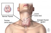 Ciri-ciri Gangguan Tiroid yang Muncul di Pagi Hari